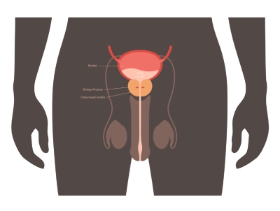dyzúria zväčšená prostata